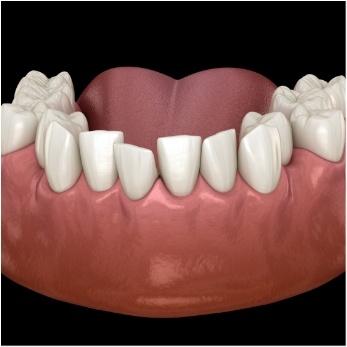 Digital image of crowded or crooked teeth