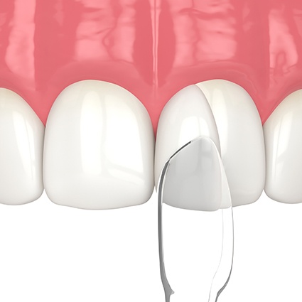 Rendering of composite resin being applied to a tooth