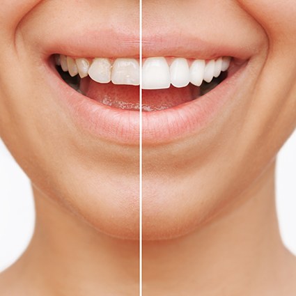 Nose-to-neck image of a woman’s smile halved to show before/after cosmetic treatment