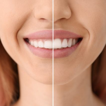 Womans smile before and after gum recontouring