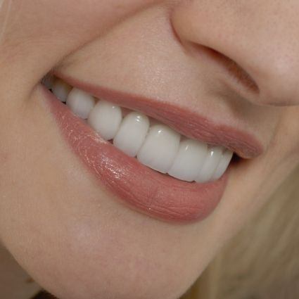 Close up of womans smile after smile makeover