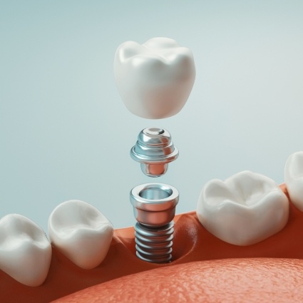 Illustration of dental implant in Rogers with abutment and crown being placed