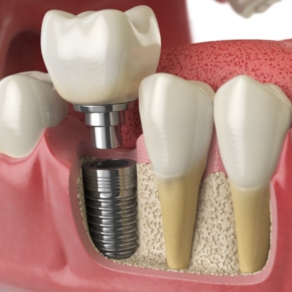 Illustration of dental crown being attached to dental implant in jaw