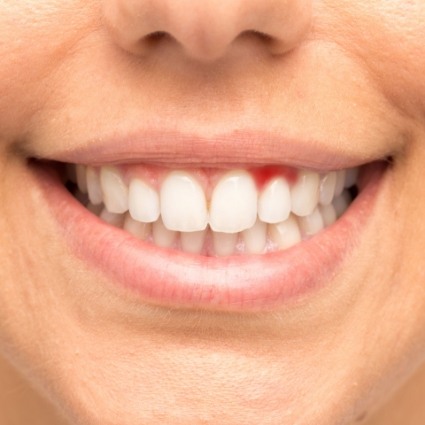 Close up of smile with inflamed gums