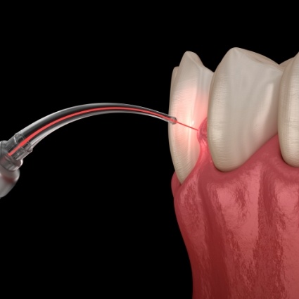 Illustration of laser being used for gum disease treatment in Rogers