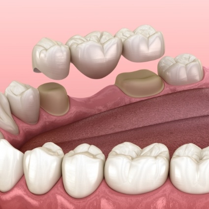 Illustration of dental bridge being attached to teeth