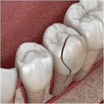 Illustration of a chipped tooth from the side