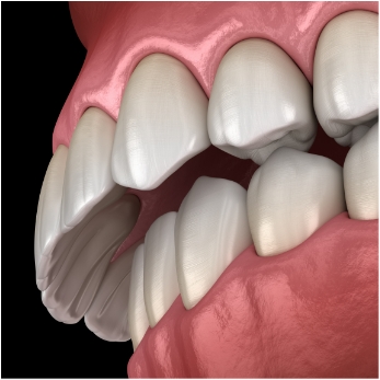 Illustration of an overbite