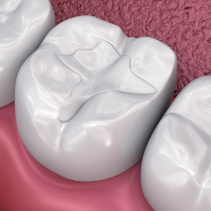 Illustration of teeth with dental sealants