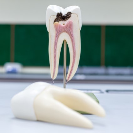 Model of decayed tooth needing root canal treatment in Rogers