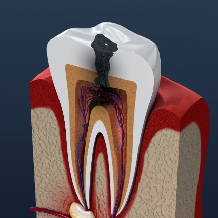 Illustration of a badly decayed and infected tooth