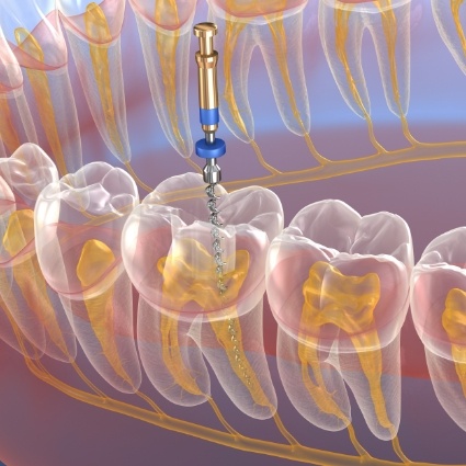 Illustration of teeth receiving root canal treatment