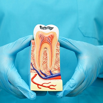 Dentist holding a model of a decayed tooth