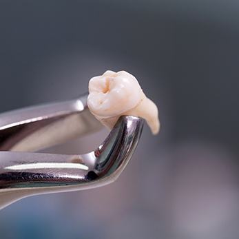 Forceps holding an extracted tooth