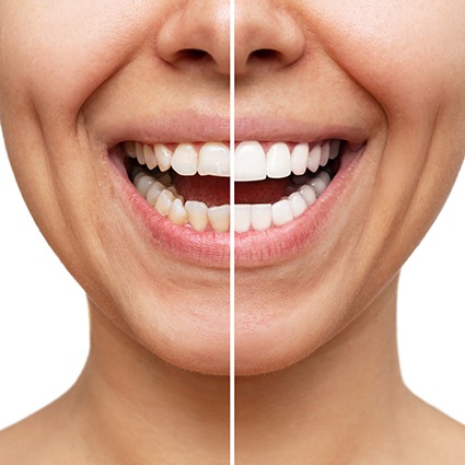 Nose-to-neck view of woman smiling split in half to show before/after veneers