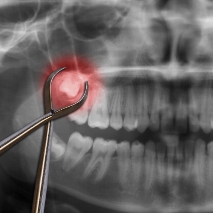 Close up of dental X ray with impacted wisdom tooth