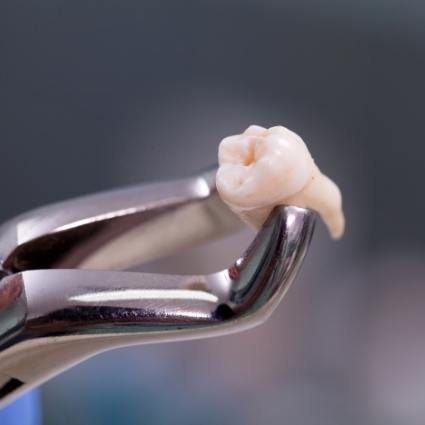 Close up of an extracted tooth held in forceps